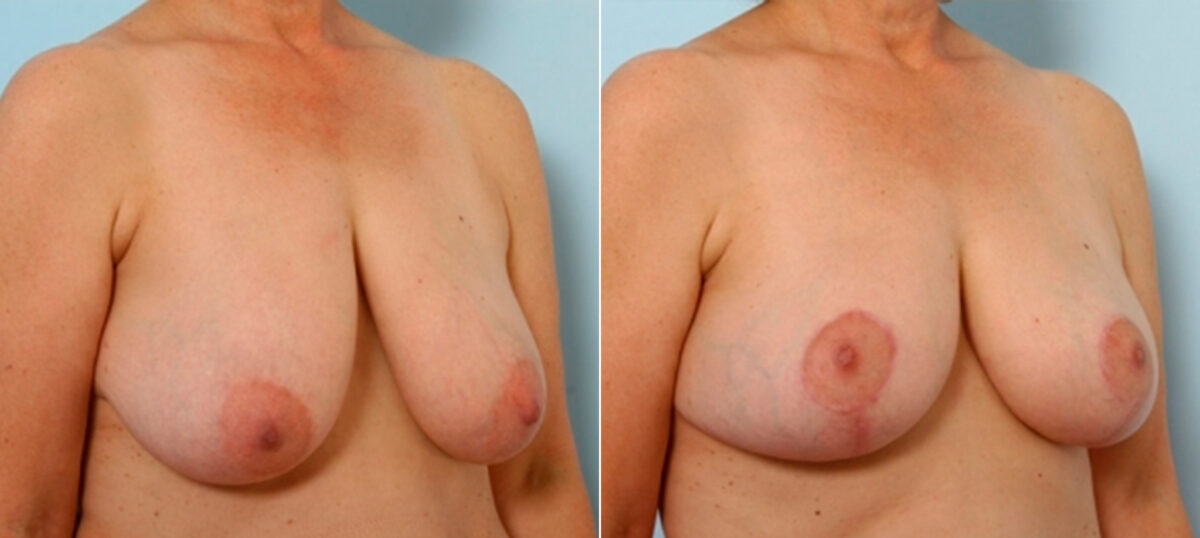 Breast Lift before and after photos in Houston, TX, Patient 27442