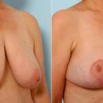 Breast Lift before and after photos in Houston, TX, Patient 27442