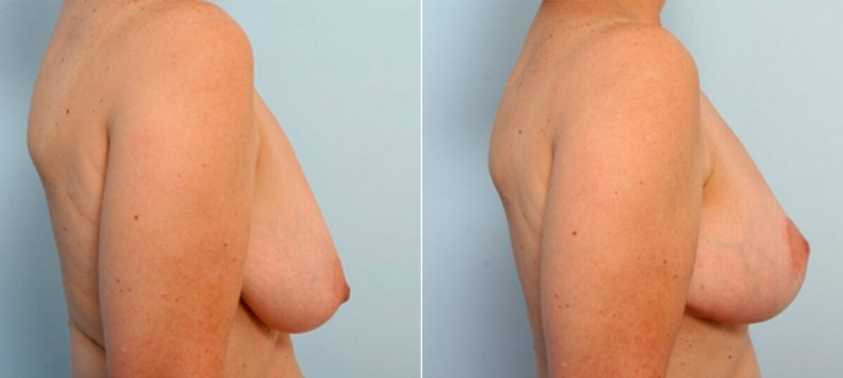 Breast Lift before and after photos in Houston, TX, Patient 27442