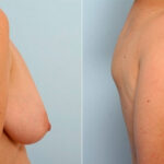Breast Lift before and after photos in Houston, TX, Patient 27442