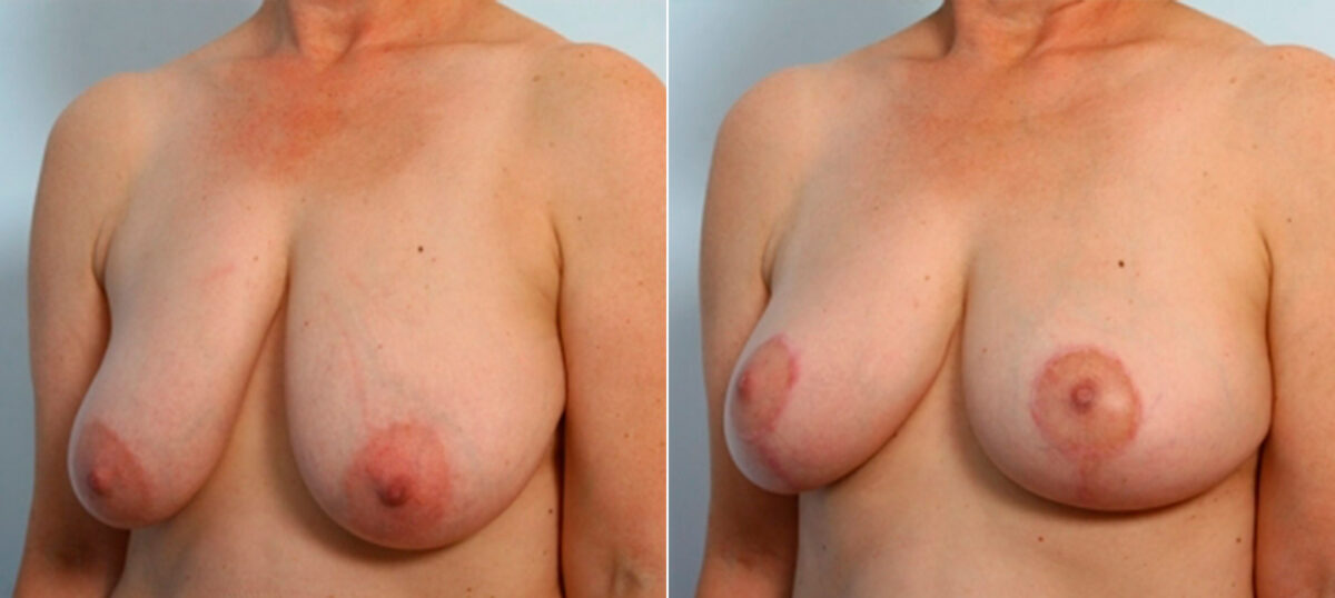 Breast Lift before and after photos in Houston, TX, Patient 27442