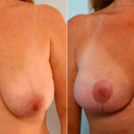 Breast Lift before and after photos in Houston, TX, Patient 27453