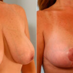 Breast Lift before and after photos in Houston, TX, Patient 27453
