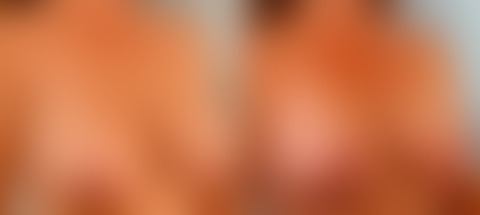 Breast Lift before and after photos in Houston, TX, Patient 27453