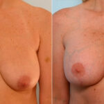 Breast Lift with Augmentation before and after photos in Houston, TX, Patient 27462