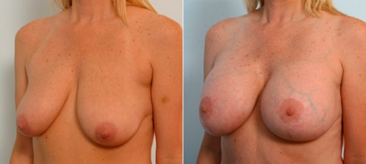 Breast Lift with Augmentation before and after photos in Houston, TX, Patient 27462