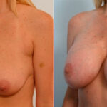 Breast Lift with Augmentation before and after photos in Houston, TX, Patient 27462