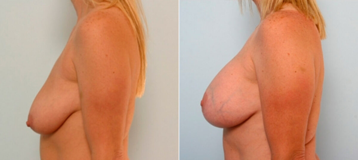 Breast Lift with Augmentation before and after photos in Houston, TX, Patient 27462