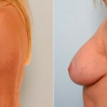 Breast Lift with Augmentation before and after photos in Houston, TX, Patient 27462