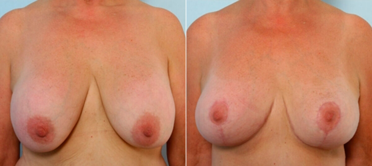 Breast Lift with Augmentation before and after photos in Houston, TX, Patient 27478