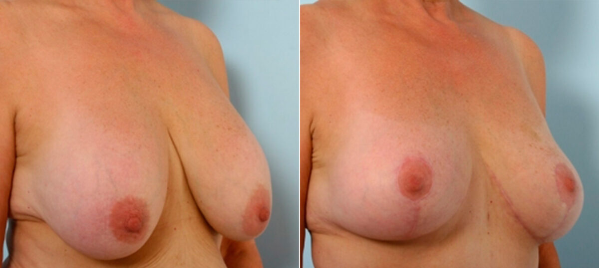 Breast Lift with Augmentation before and after photos in Houston, TX, Patient 27478