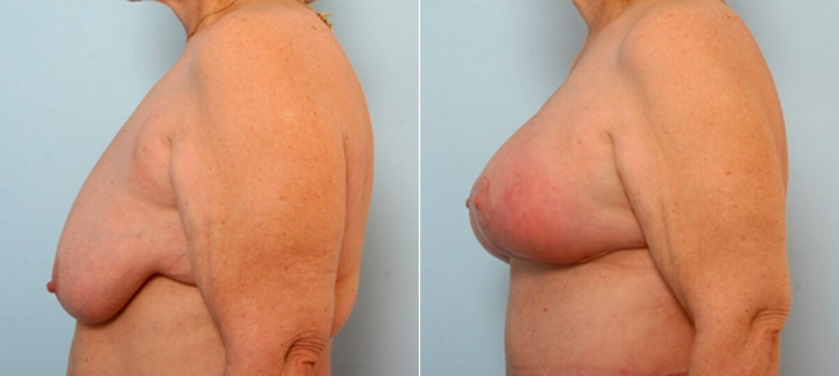 Breast Lift with Augmentation before and after photos in Houston, TX, Patient 27496