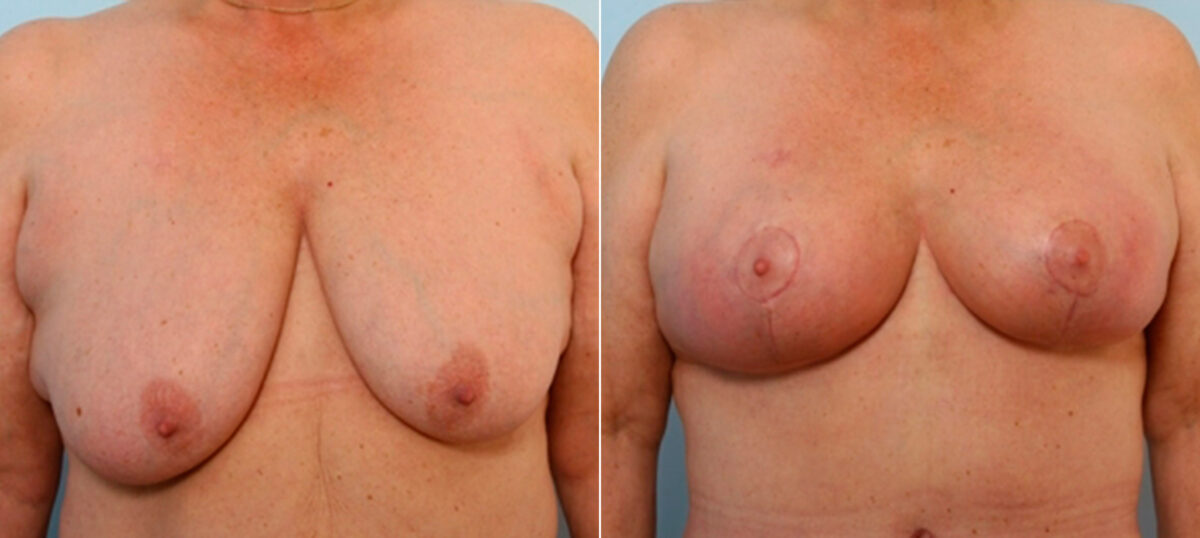 Breast Lift with Augmentation before and after photos in Houston, TX, Patient 27496