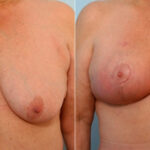 Breast Lift with Augmentation before and after photos in Houston, TX, Patient 27496