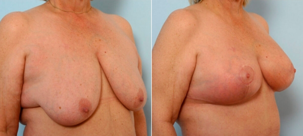 Breast Lift with Augmentation before and after photos in Houston, TX, Patient 27496