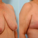 Breast Lift with Augmentation before and after photos in Houston, TX, Patient 27496