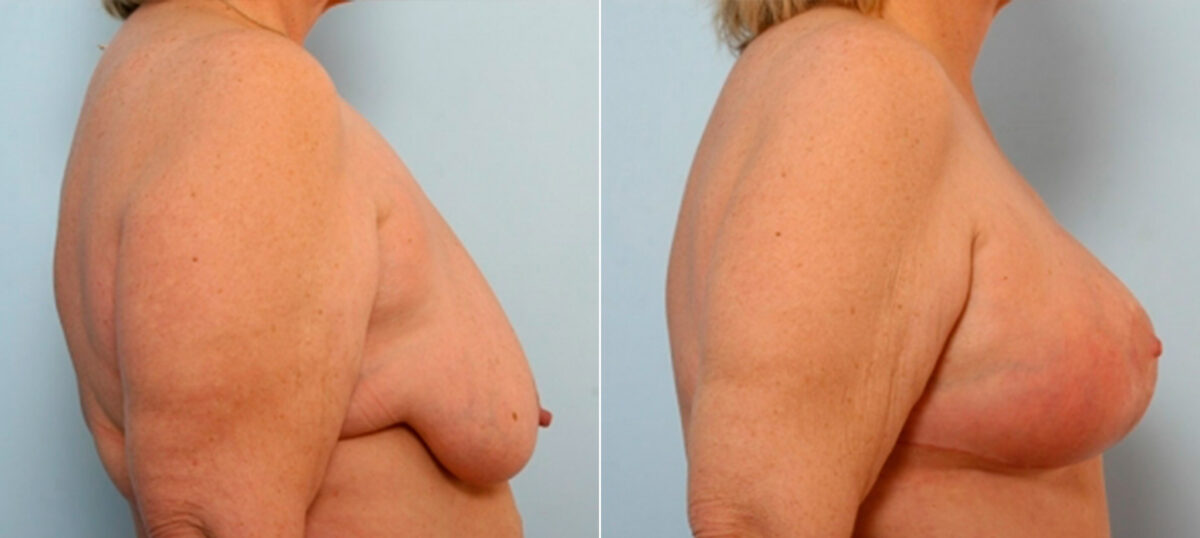 Breast Lift with Augmentation before and after photos in Houston, TX, Patient 27496