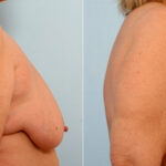 Breast Lift with Augmentation before and after photos in Houston, TX, Patient 27496