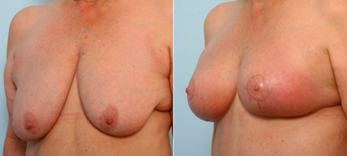 Breast Lift with Augmentation before and after photos in Houston, TX, Patient 27496