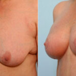 Breast Lift with Augmentation before and after photos in Houston, TX, Patient 27496