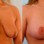 Breast Lift with Augmentation before and after photos in Houston, TX, Patient 27507