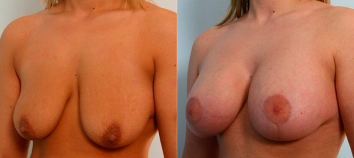 Breast Lift with Augmentation before and after photos in Houston, TX, Patient 27507