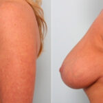 Breast Lift with Augmentation before and after photos in Houston, TX, Patient 27516