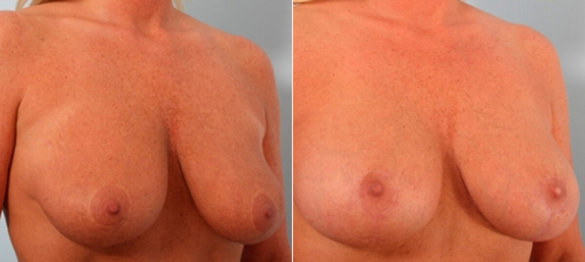 Breast Lift with Augmentation before and after photos in Houston, TX, Patient 27516