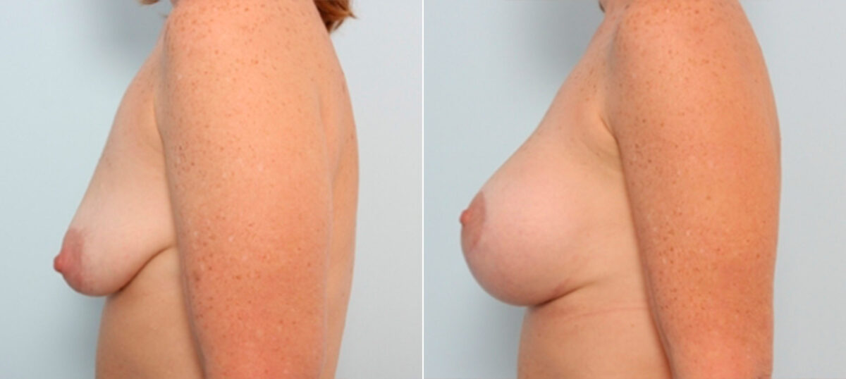 Breast Lift with Augmentation before and after photos in Houston, TX, Patient 27527