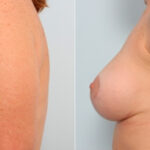 Breast Lift with Augmentation before and after photos in Houston, TX, Patient 27527