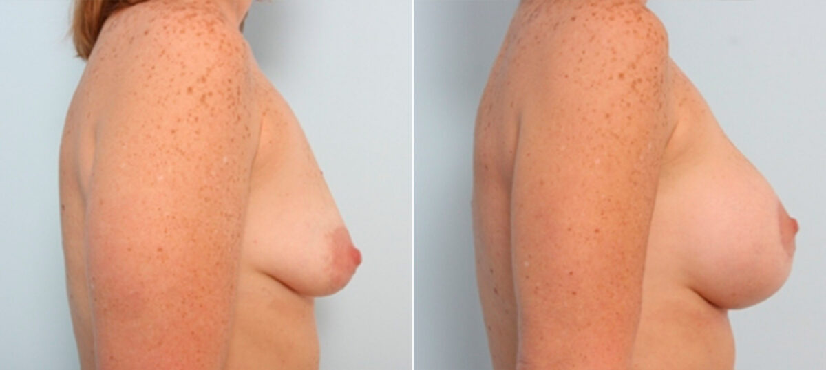 Breast Lift with Augmentation before and after photos in Houston, TX, Patient 27527