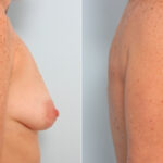 Breast Lift with Augmentation before and after photos in Houston, TX, Patient 27527