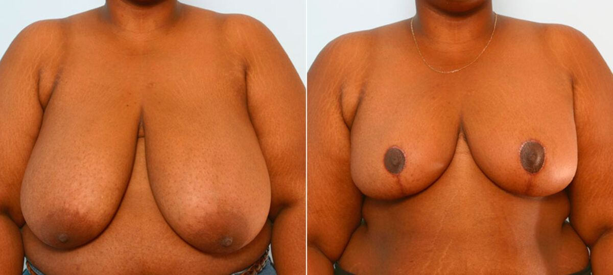 Breast Reduction before and after photos in Houston, TX, Patient 27538