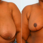 Breast Reduction before and after photos in Houston, TX, Patient 27538