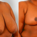 Breast Reduction before and after photos in Houston, TX, Patient 27538