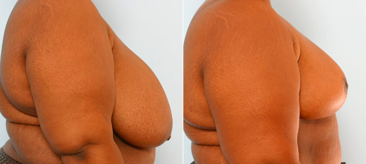Breast Reduction before and after photos in Houston, TX, Patient 27538