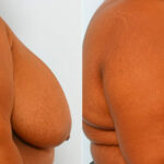 Breast Reduction before and after photos in Houston, TX, Patient 27538