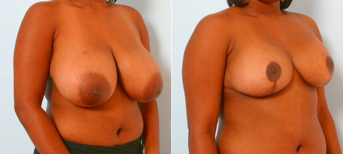 Breast Reduction before and after photos in Houston, TX, Patient 27545