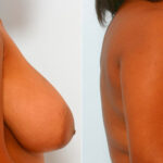 Breast Reduction before and after photos in Houston, TX, Patient 27545