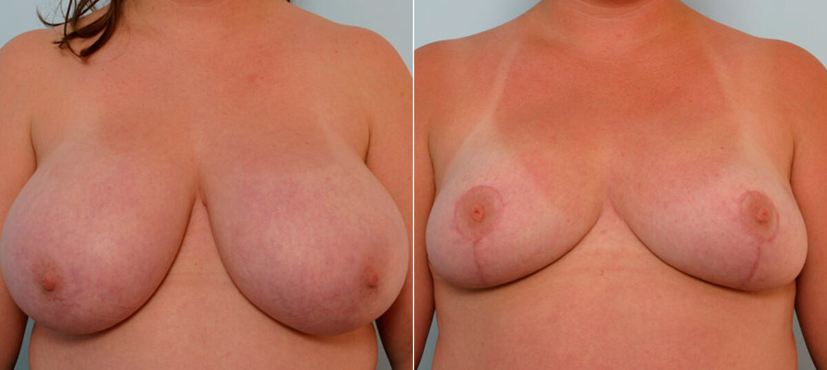 Breast Reduction before and after photos in Houston, TX, Patient 27552