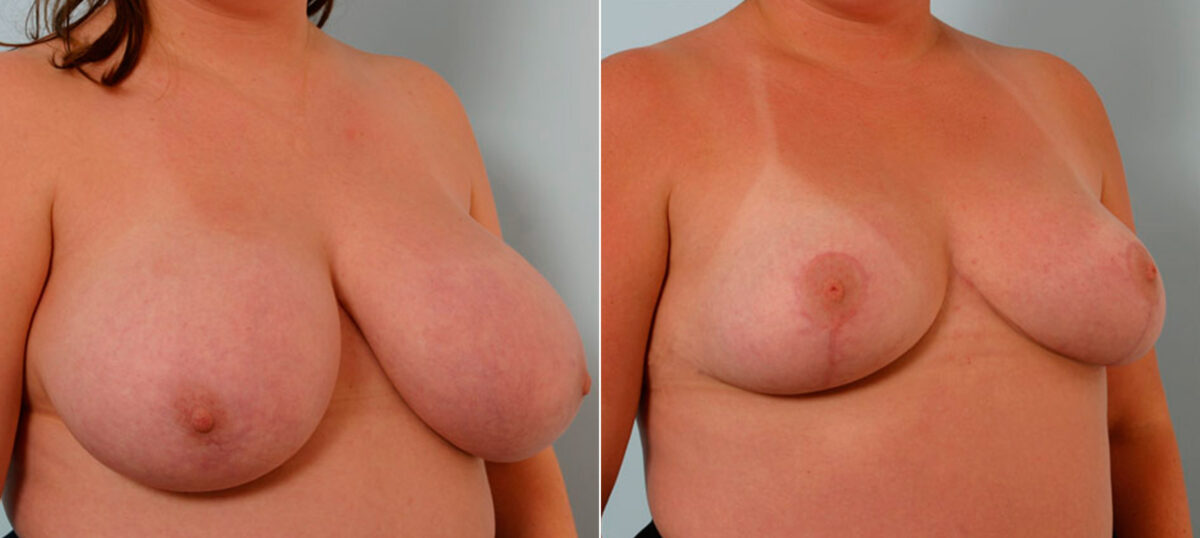 Breast Reduction before and after photos in Houston, TX, Patient 27552