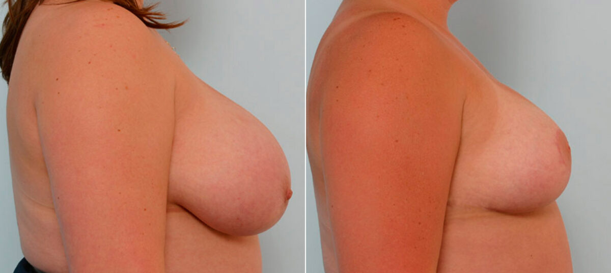 Breast Reduction before and after photos in Houston, TX, Patient 27552