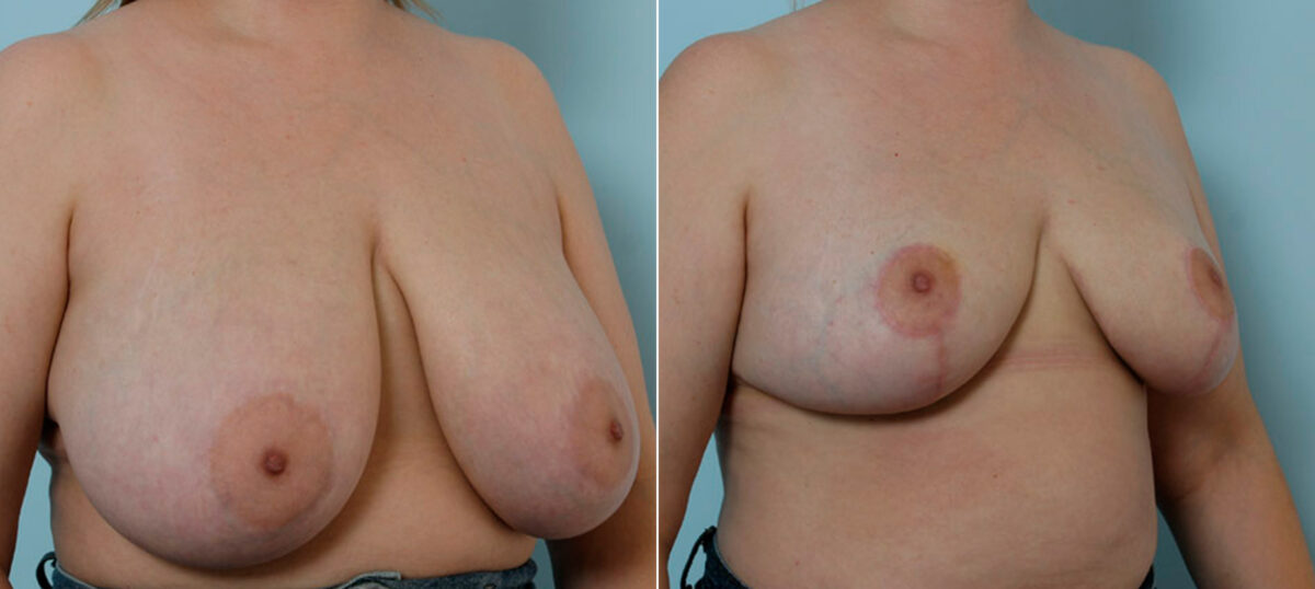 Breast Reduction before and after photos in Houston, TX, Patient 27559