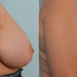Breast Reduction before and after photos in Houston, TX, Patient 27559