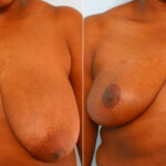 Breast Reduction before and after photos in Houston, TX, Patient 27566