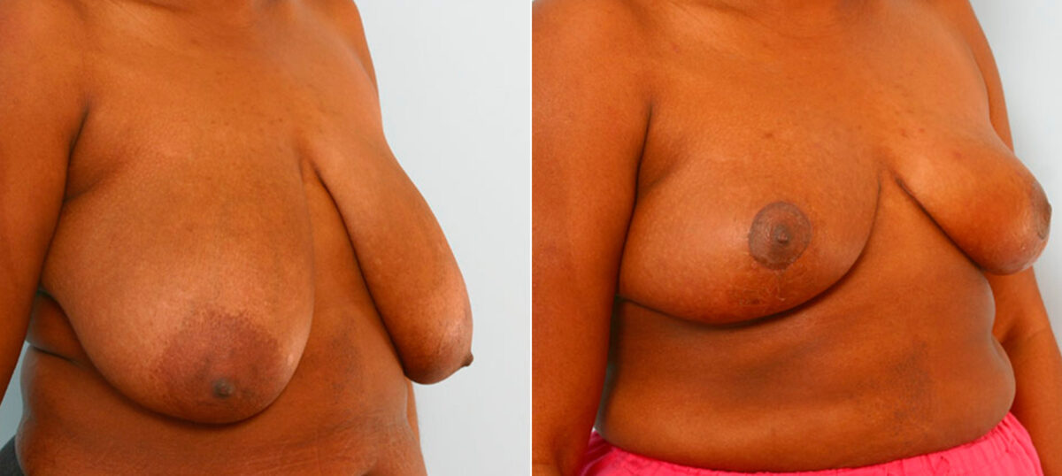 Breast Reduction before and after photos in Houston, TX, Patient 27566