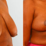 Breast Reduction before and after photos in Houston, TX, Patient 27566