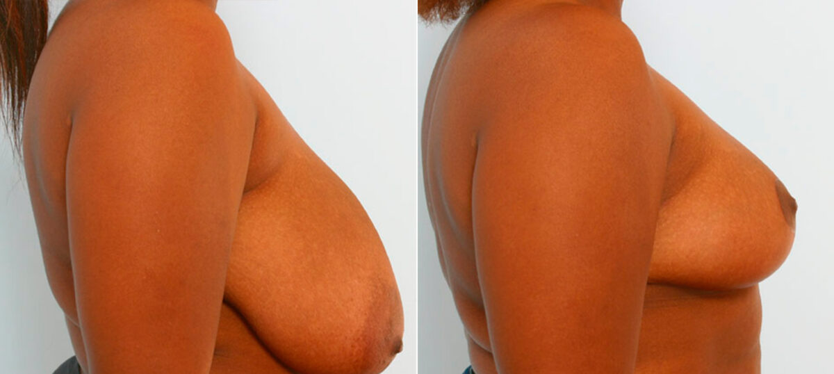 Breast Reduction before and after photos in Houston, TX, Patient 27566