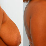 Breast Reduction before and after photos in Houston, TX, Patient 27566