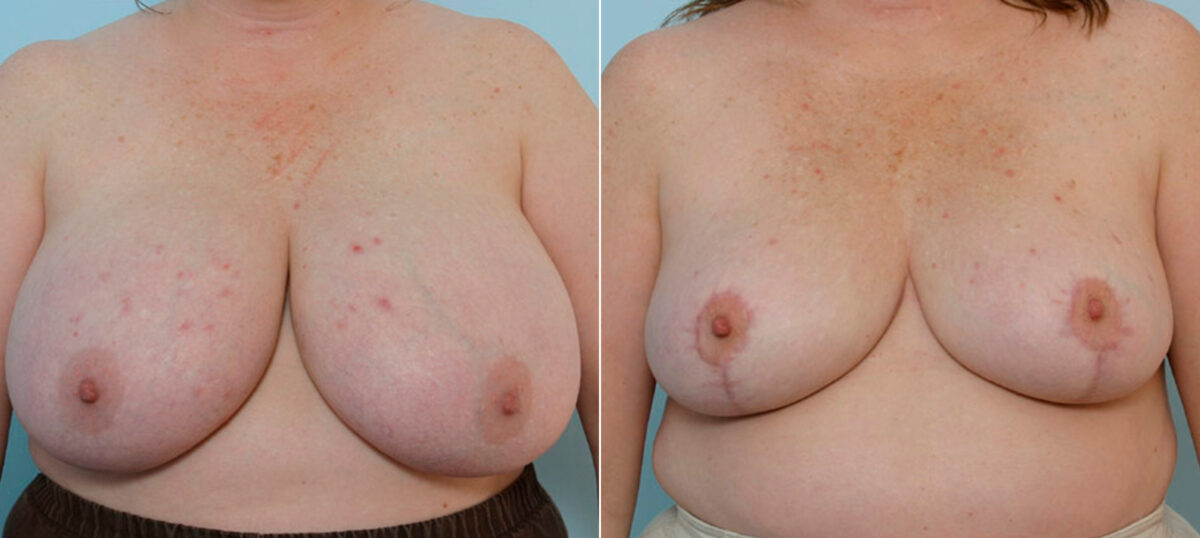 Breast Reduction before and after photos in Houston, TX, Patient 27573